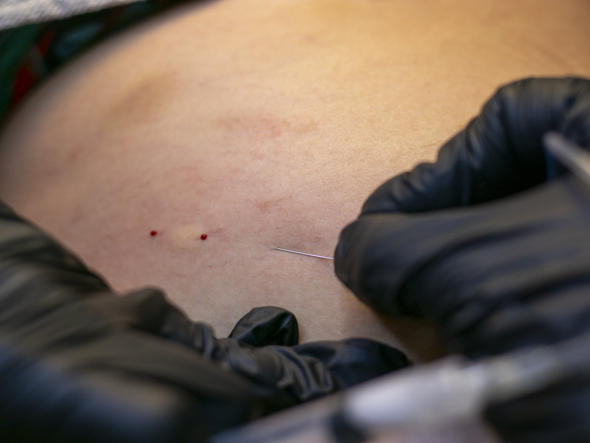 Close-up of a needle being inserted into skin with two small blood drops nearby, hands in black gloves.