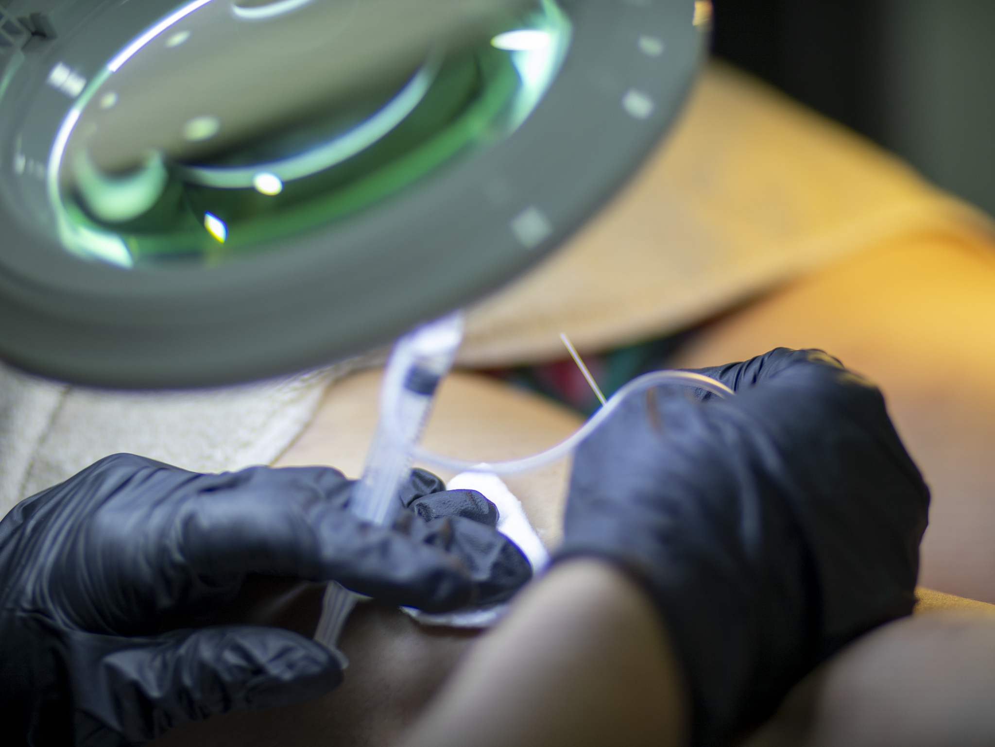 Gloved hands inserting a fine needle under a magnifying lamp during a medical or cosmetic procedure.