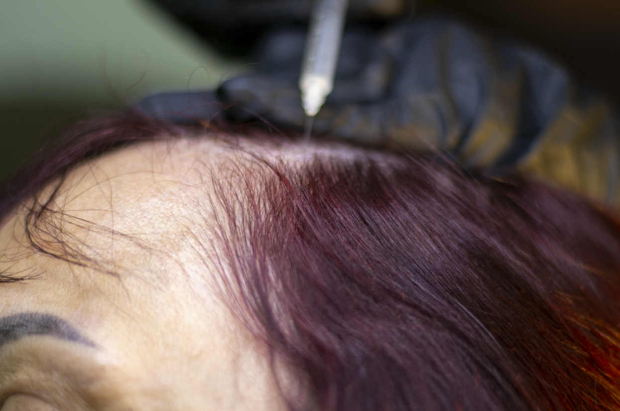 Close-up of a scalp injection procedure on a person with reddish hair and thinning hairline.