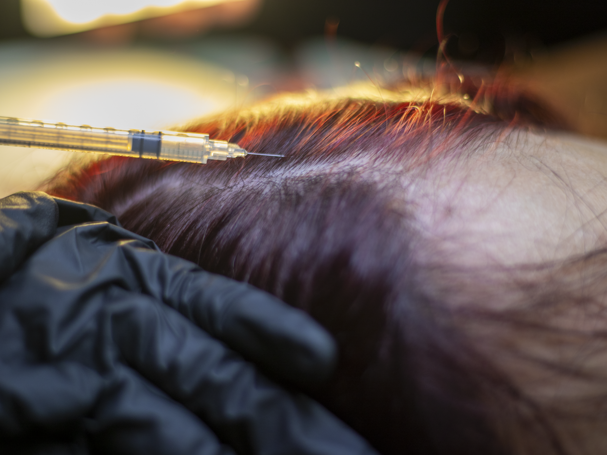 Gloved hand holding syringe injecting scalp with thinning reddish hair under warm light.