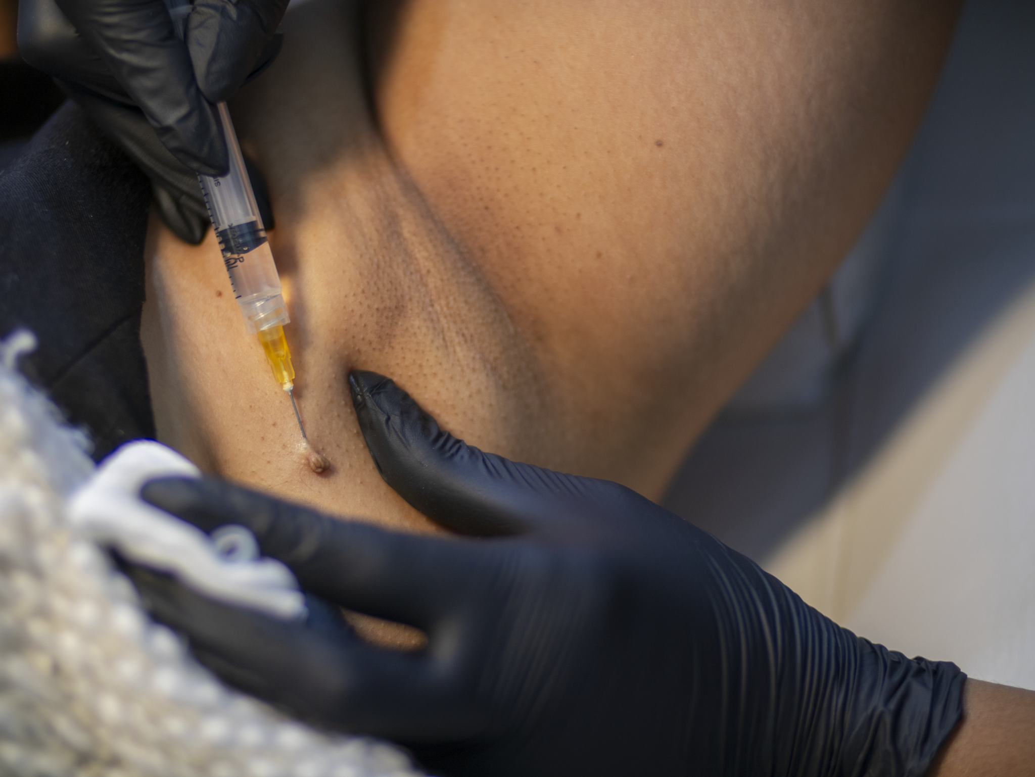 Healthcare worker with black gloves injects liquid into skin mole with syringe.