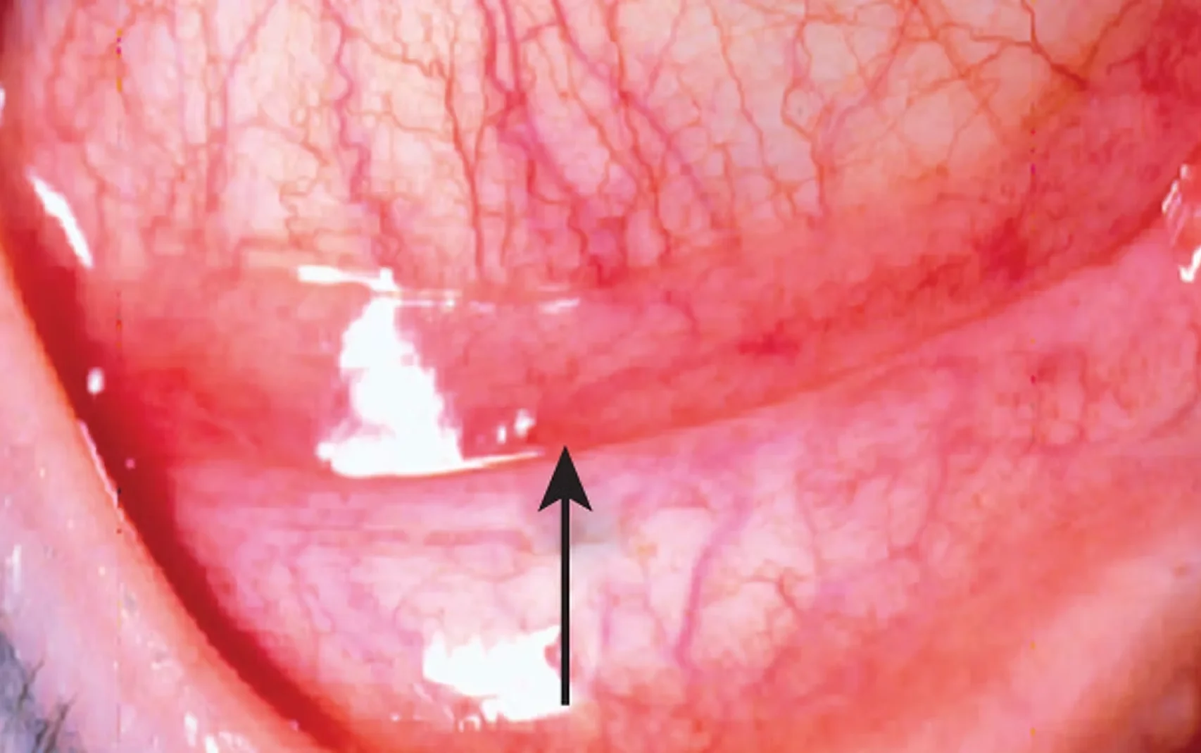 Allergic Conjunctivitis & Pink Eye Treatment