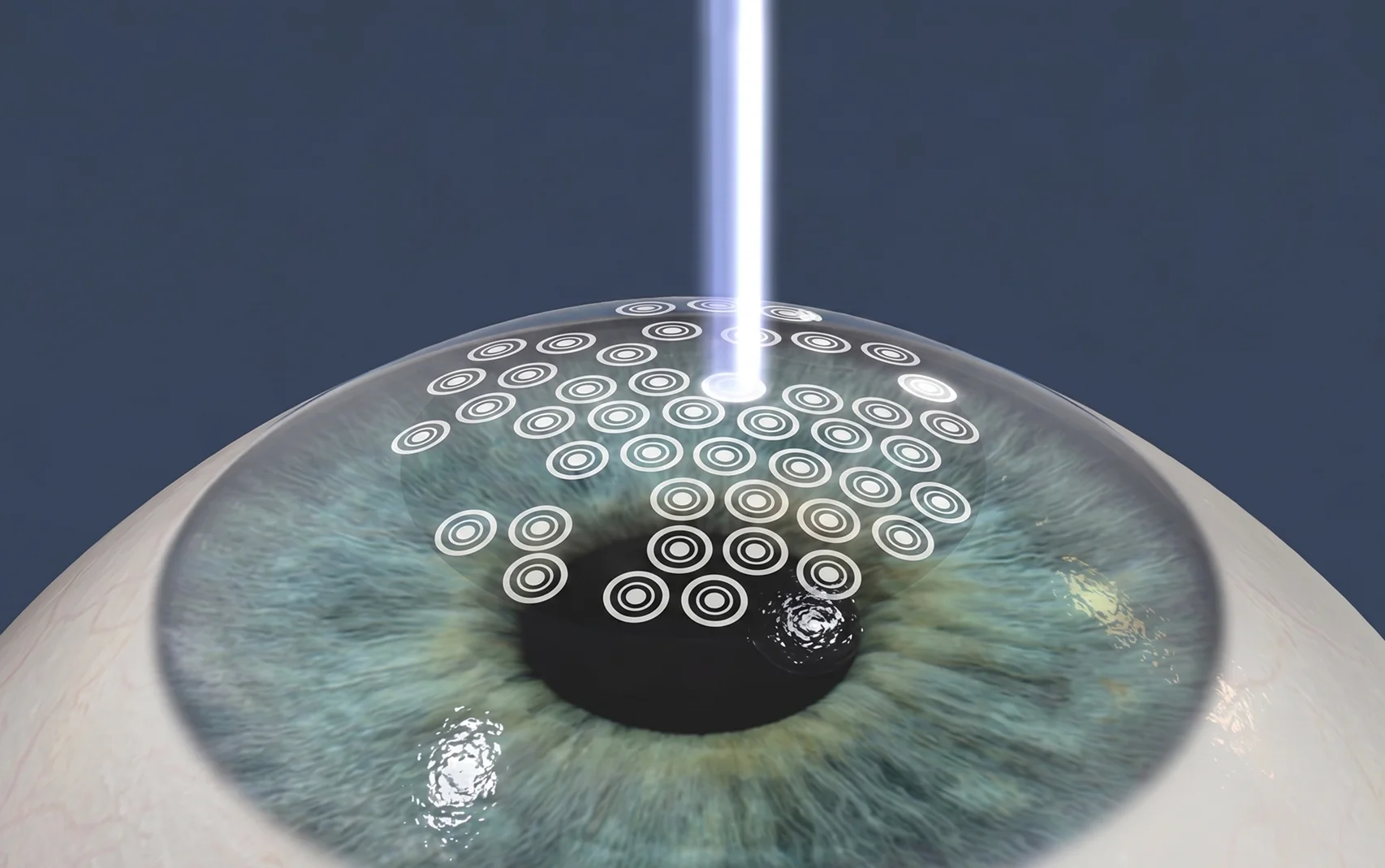 PRK & PTK Laser Surface Ablation for Clear Vision 
