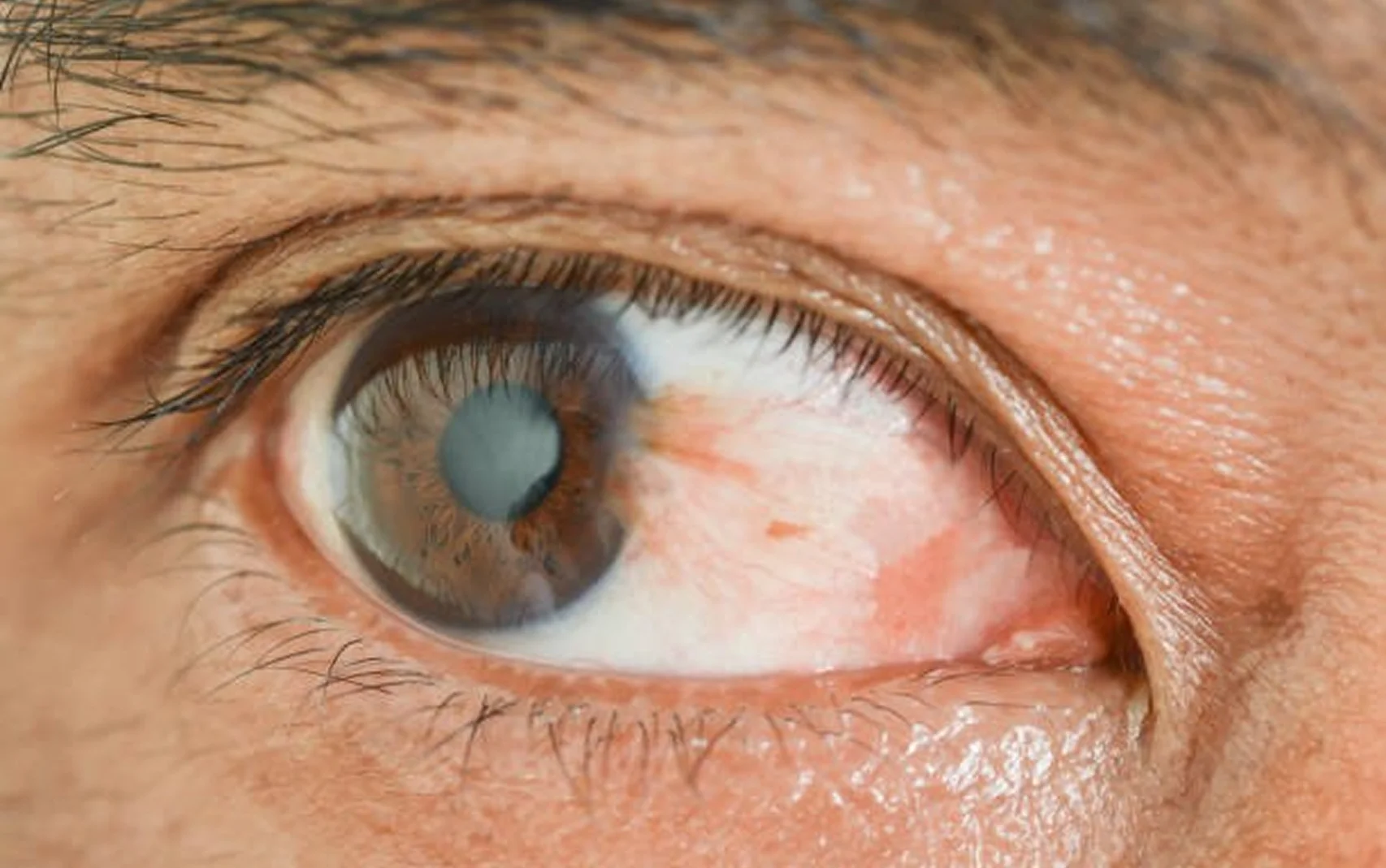 Pterygium Removal & Ocular Surface Surgery 