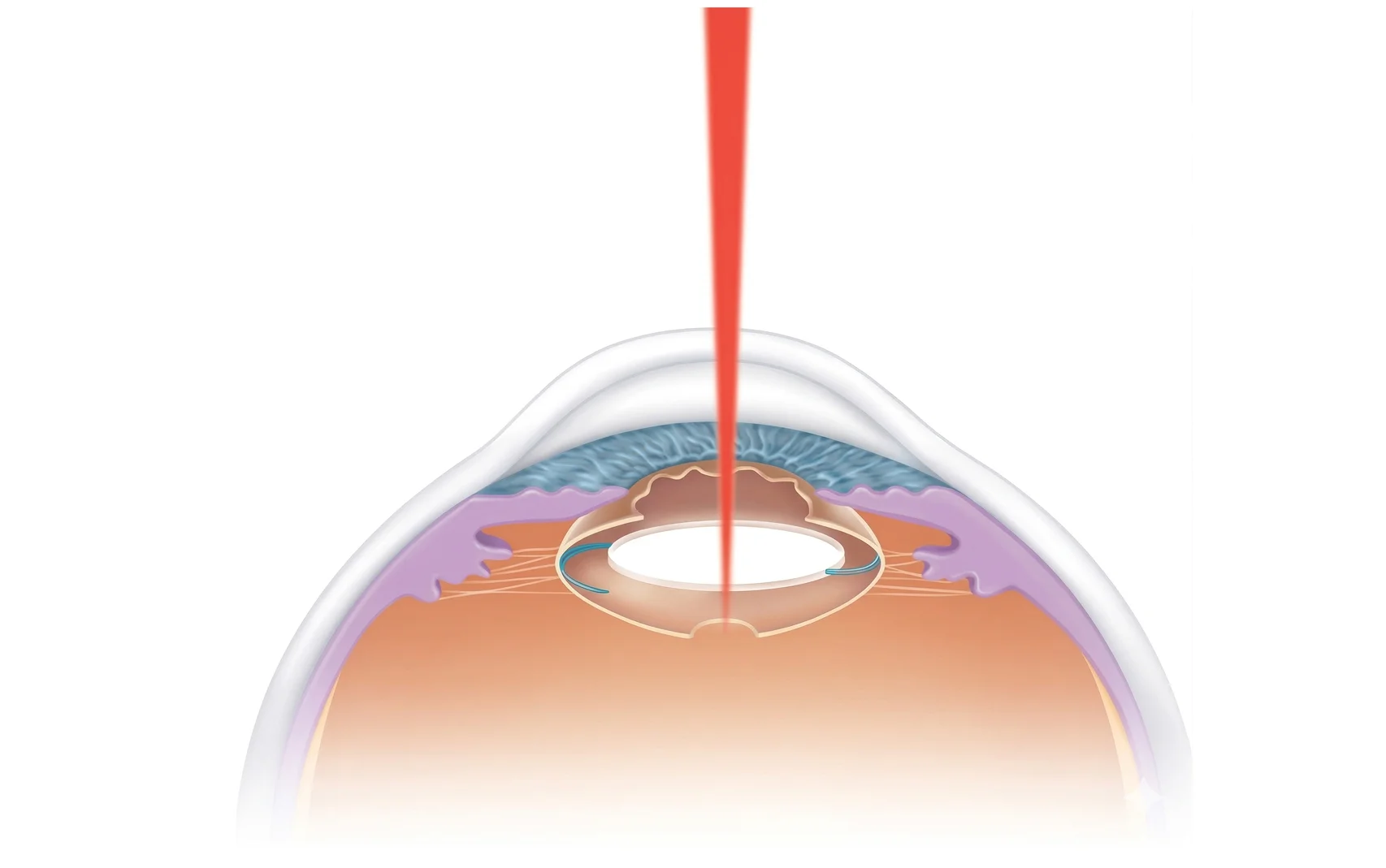 YAG Laser Capsulotomy for Clear Vision After Cataract 