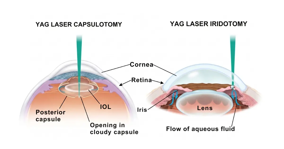 YAG Laser Capsulotomy for Clear Vision After Cataract 