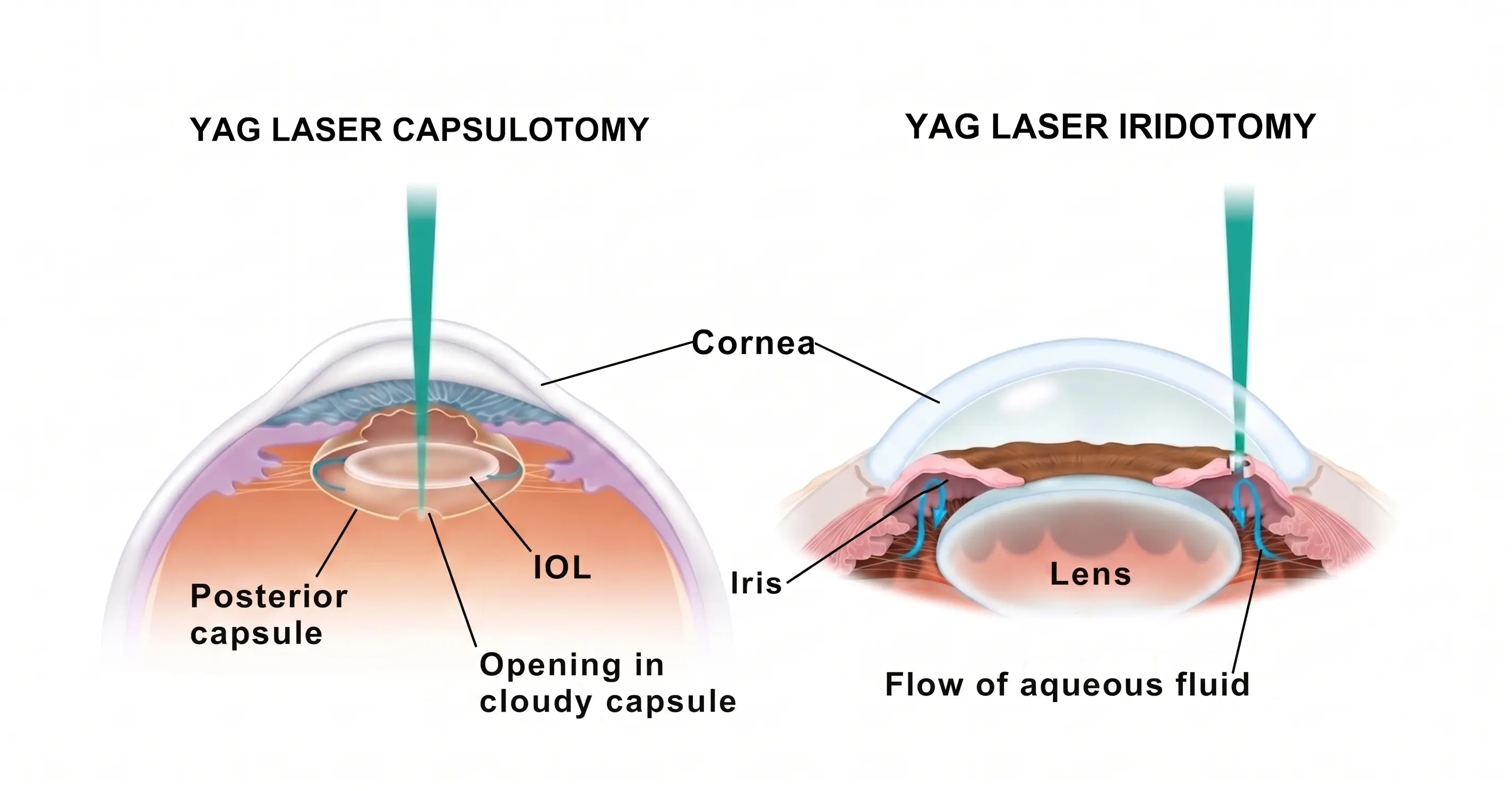 YAG Laser Capsulotomy for Clear Vision After Cataract 