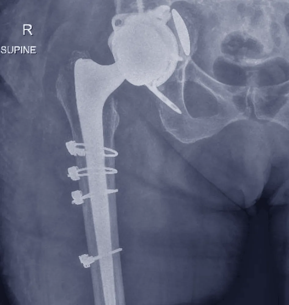 X-ray of a hip showing a revision hip replacement.