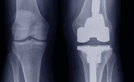 X-ray of both knees showing total knee replacement implants, used to illustrate the anatomy involved in revision knee replacement surgery.