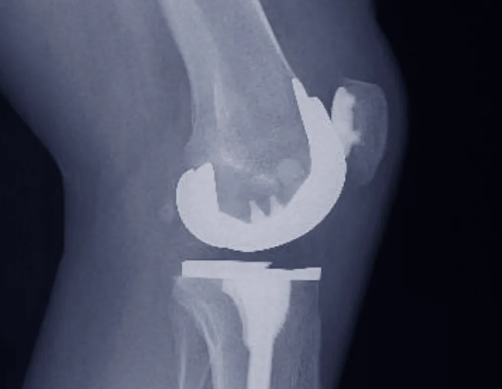 X-ray of a knee showing a total knee replacement implant replacing the damaged joint.