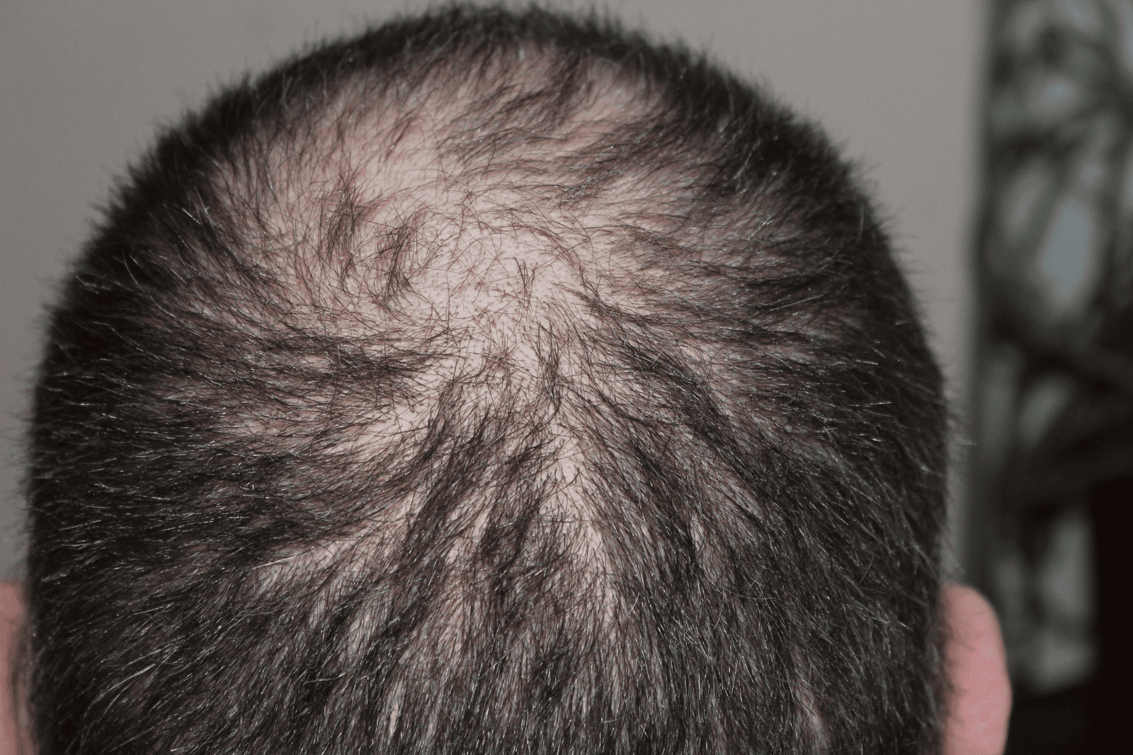 Haarausfall behandeln in Düsseldorf: Exosomen, Cellbooster & PRP