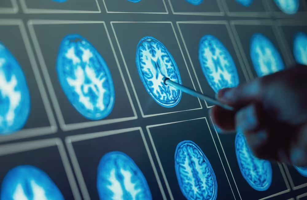 Brain Tumours. Pointing out a brain Tumour on medical scan close up