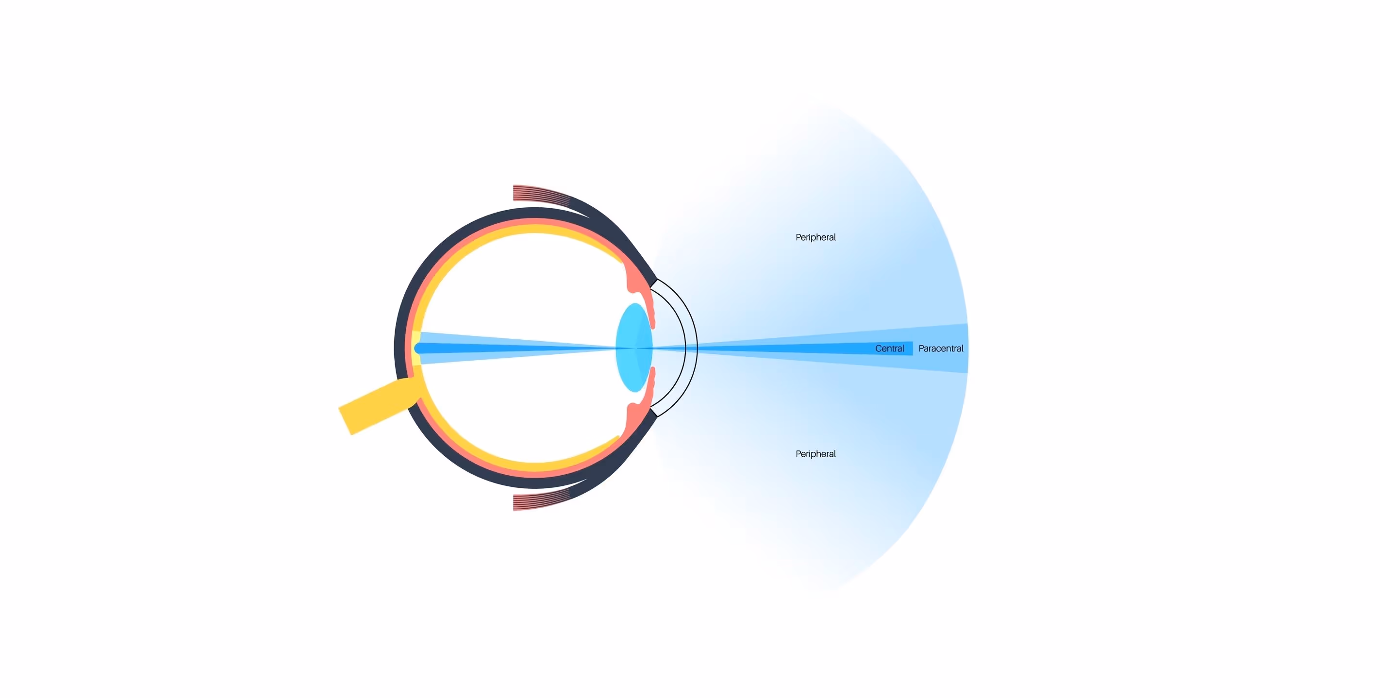 Contact Lenses Improve Vision Quality