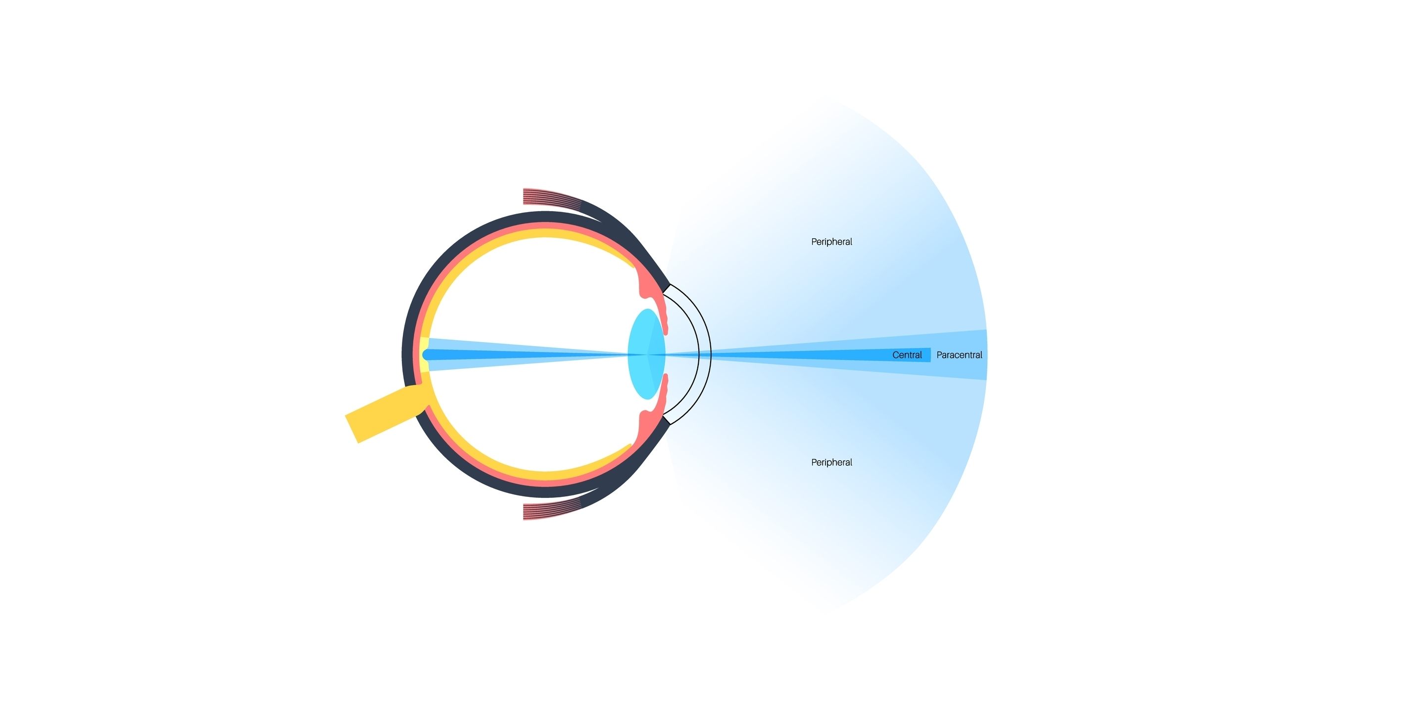 Contact Lenses Improve Vision Quality