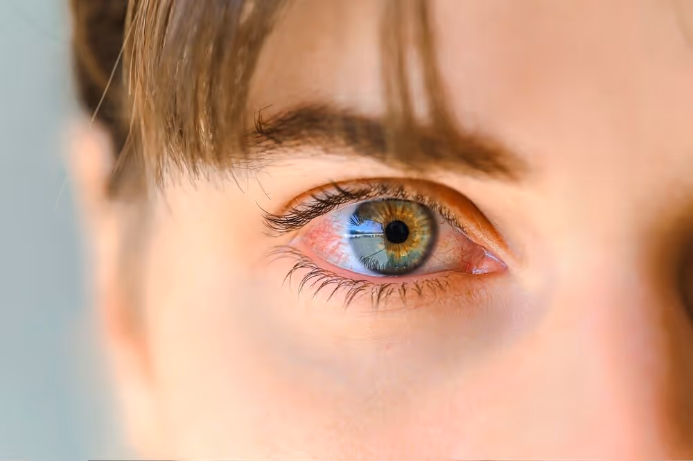 Dry Eye Treatment
