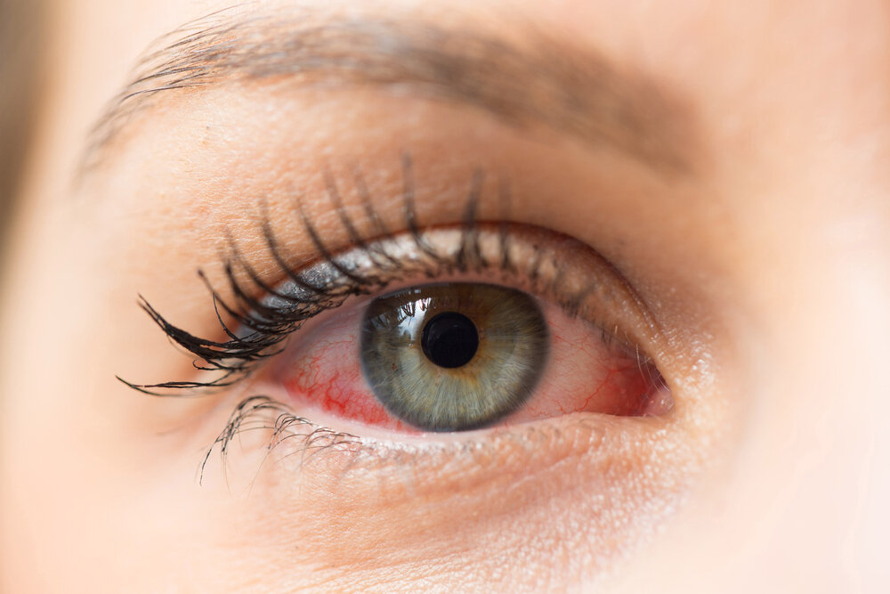 Dry Eyes. Eyes ZEST. Red blood shot eye.
