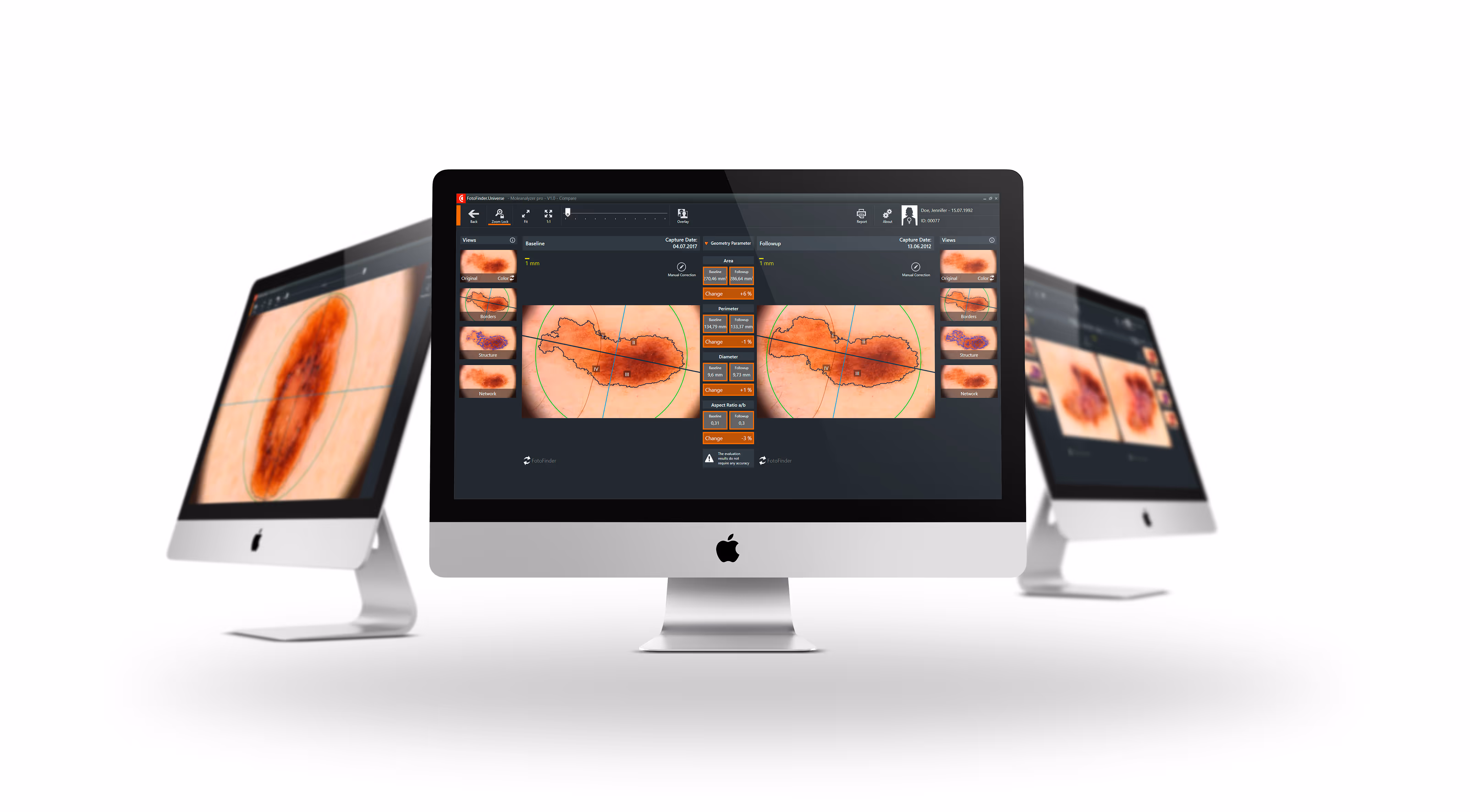 Drei Apple iMac-Computer zeigen Hautanalyse-Software mit vergrößerter Aufnahme von Hautmale zur Melanom-Erkennung.