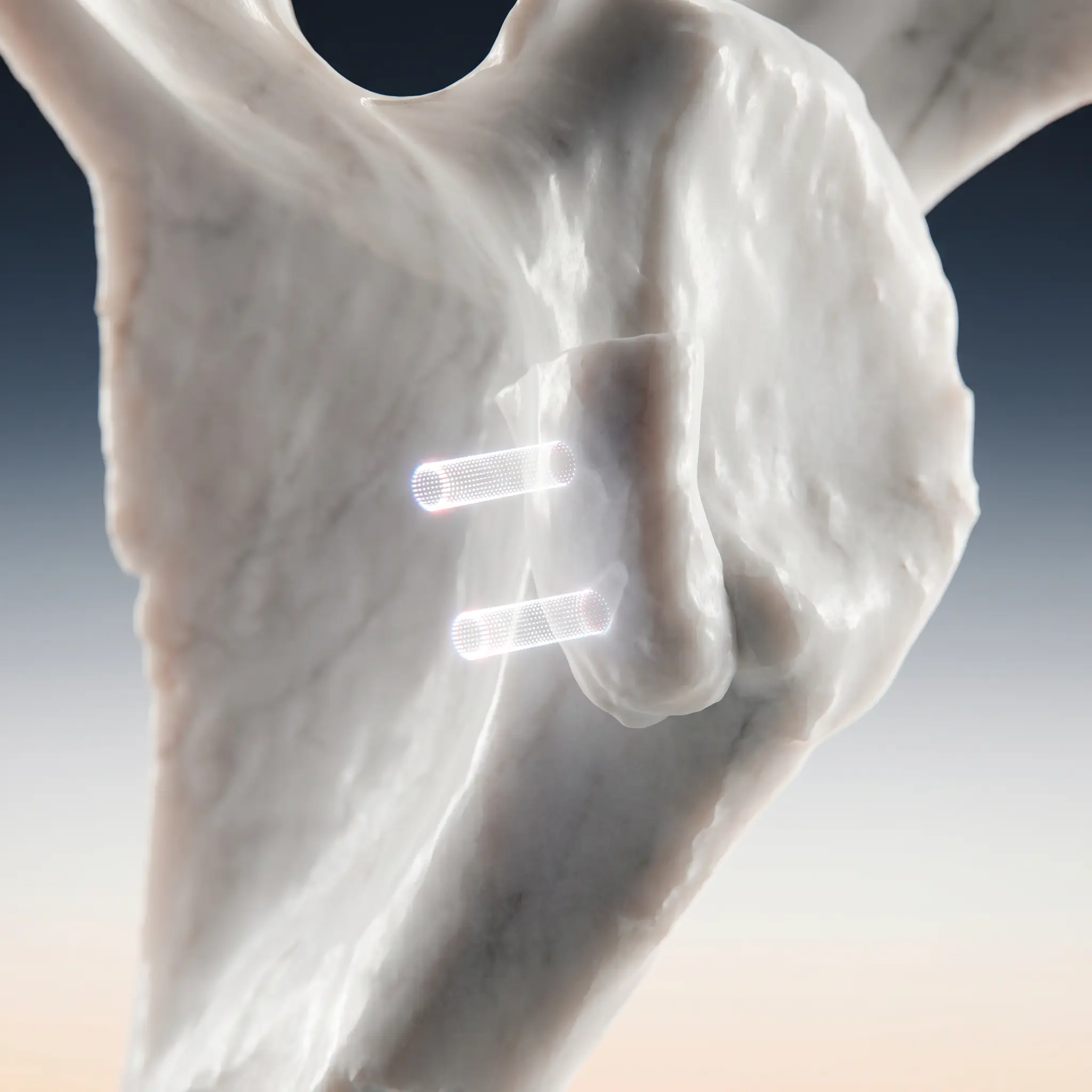 Latarjet