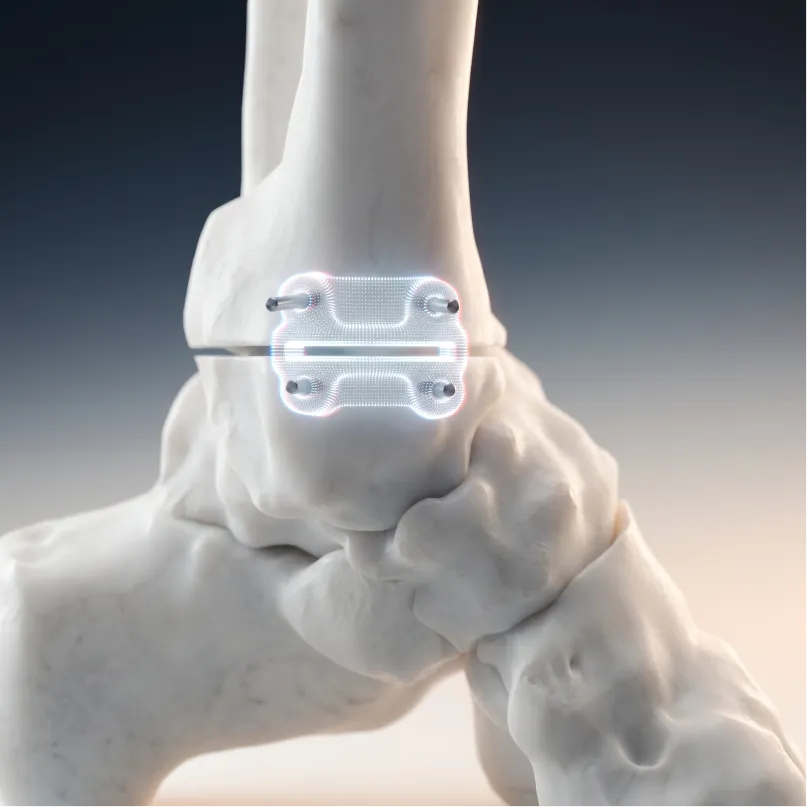 Palfondplasty