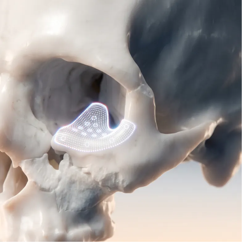 Orbital Floor - Titanium Implant