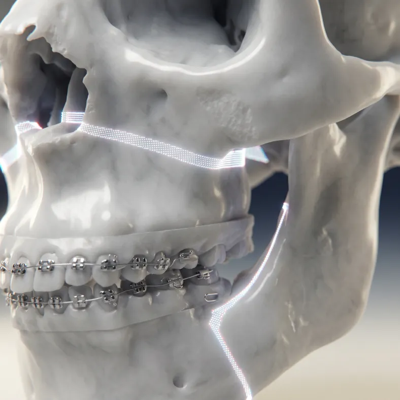 Orthognathic Surgery