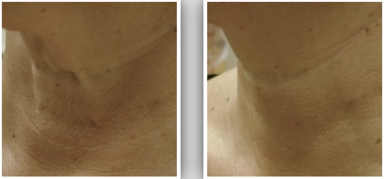 Close-up comparison of a person's neck before and after skincare treatment showing smoother skin on the right.