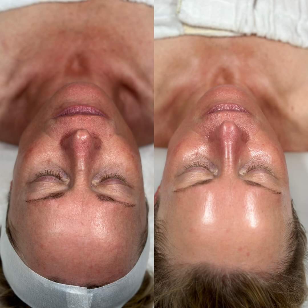 Side-by-side comparison of a woman's face before and after a skincare treatment, showing smoother, more radiant skin on the right.