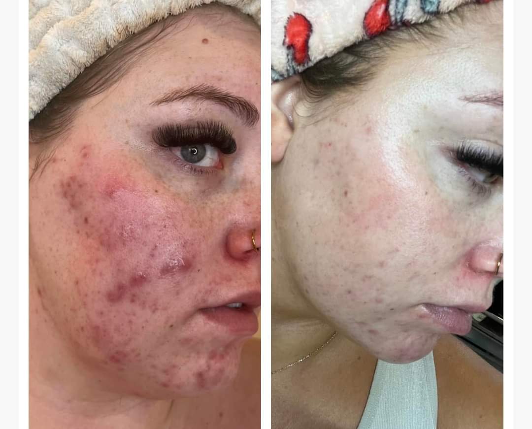 Side-by-side close-up of a woman's cheek showing before and after acne treatment; the left side shows red, inflamed acne, and the right side shows clearer skin with reduced redness.