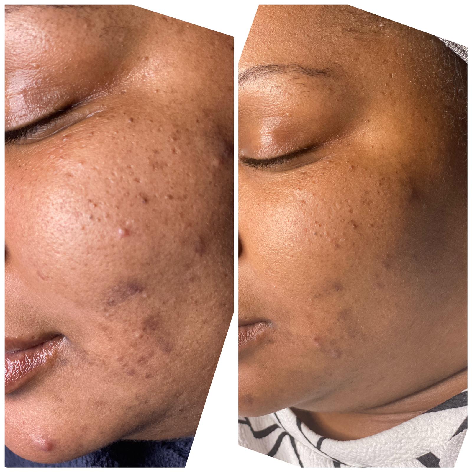 Close-up comparison of a person's cheek before and after skincare treatment showing reduced acne scars and smoother skin texture in the after image.