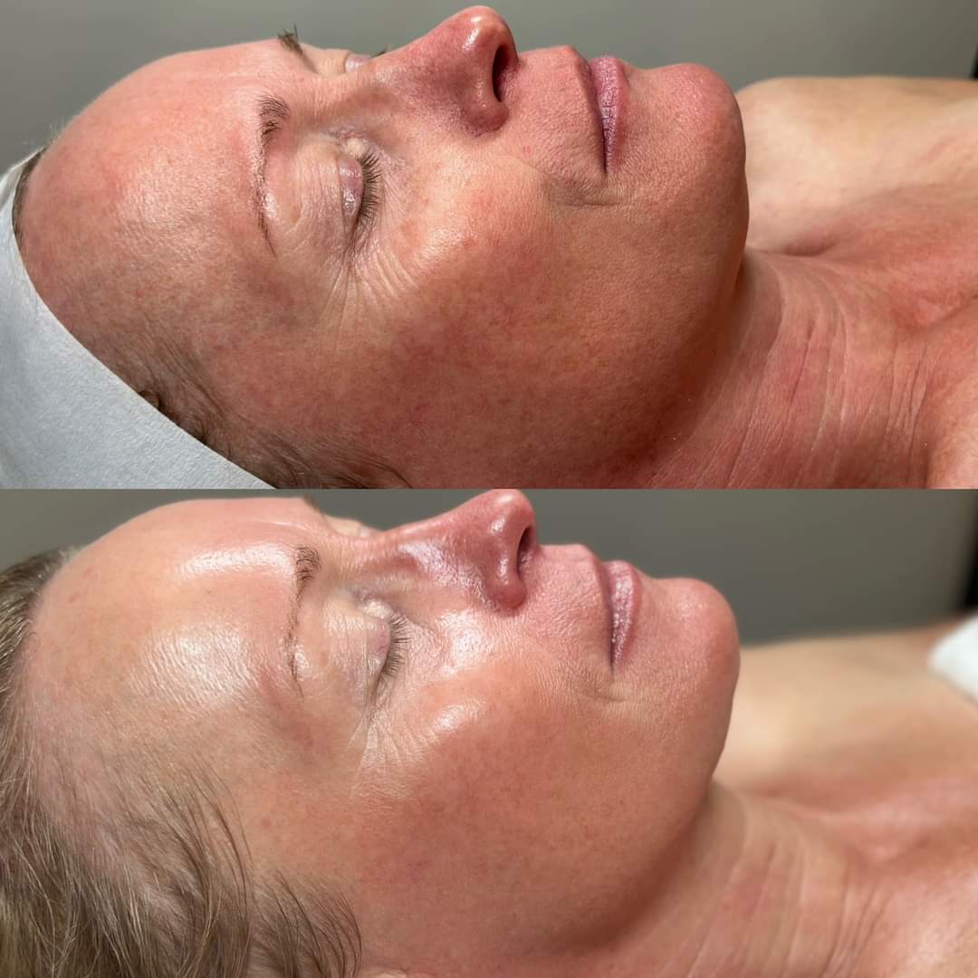 Side-by-side close-up comparison of a woman's face before and after skincare treatment showing smoother, more radiant skin in the after image.