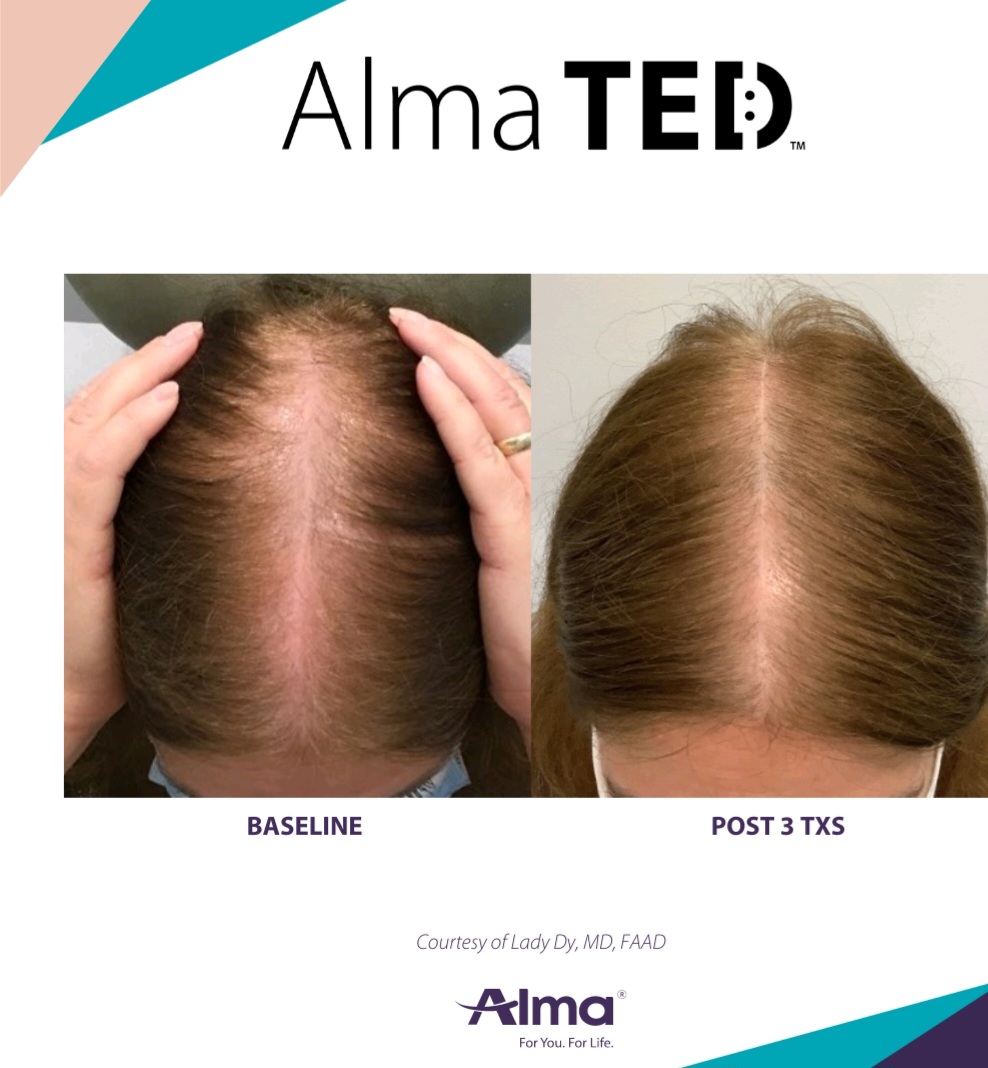 Side-by-side comparison of a person's scalp showing hair thinning at baseline and improved hair density after three Alma TED treatments.