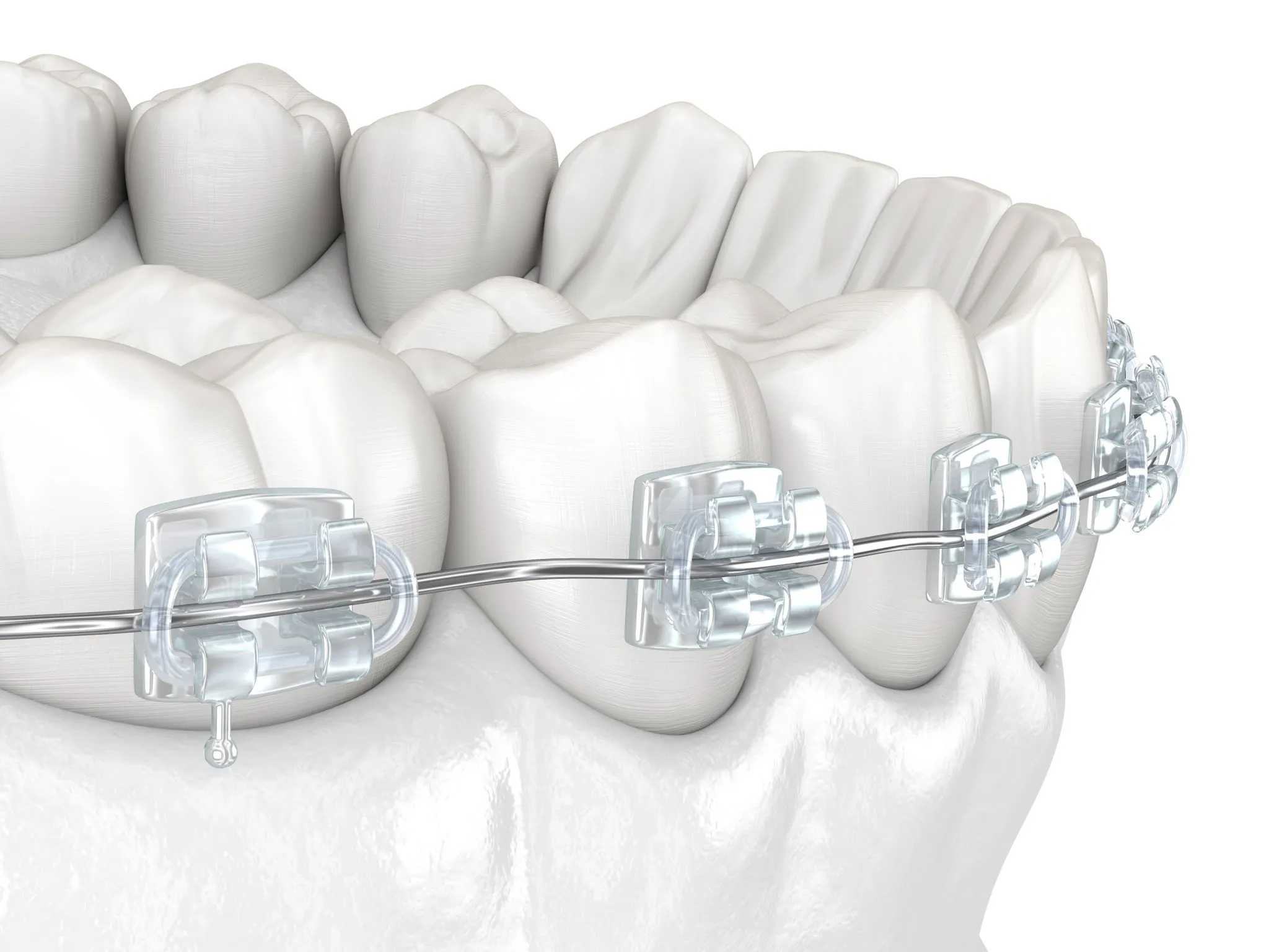 Clear ceramic braces on a model of teeth