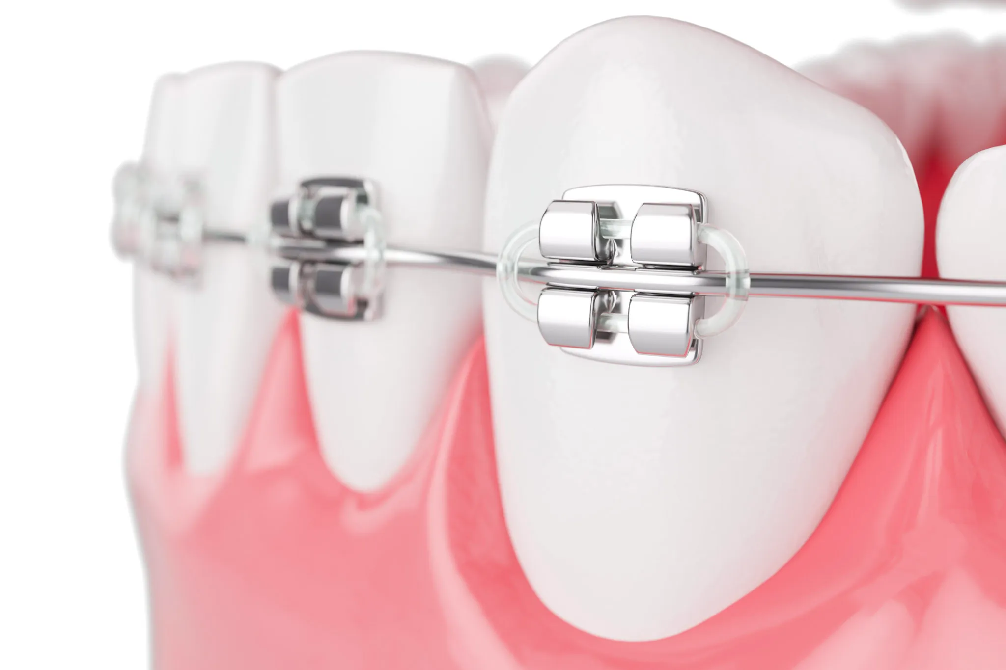 Close-up of metal braces on teeth