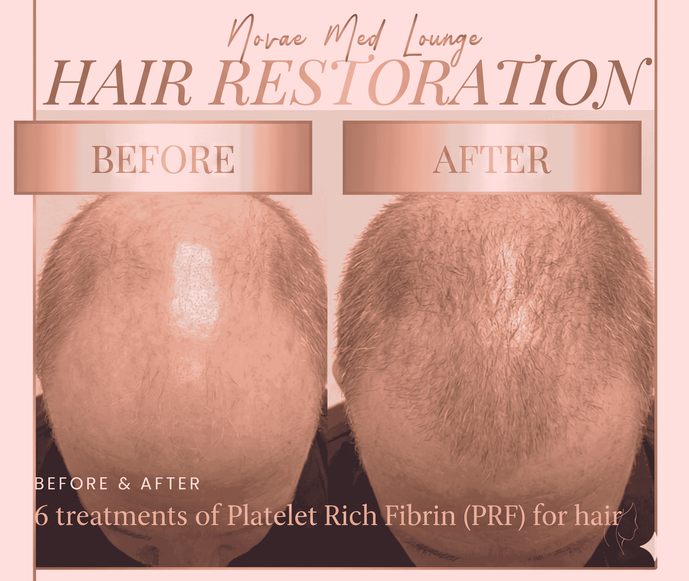 Hair Restoration