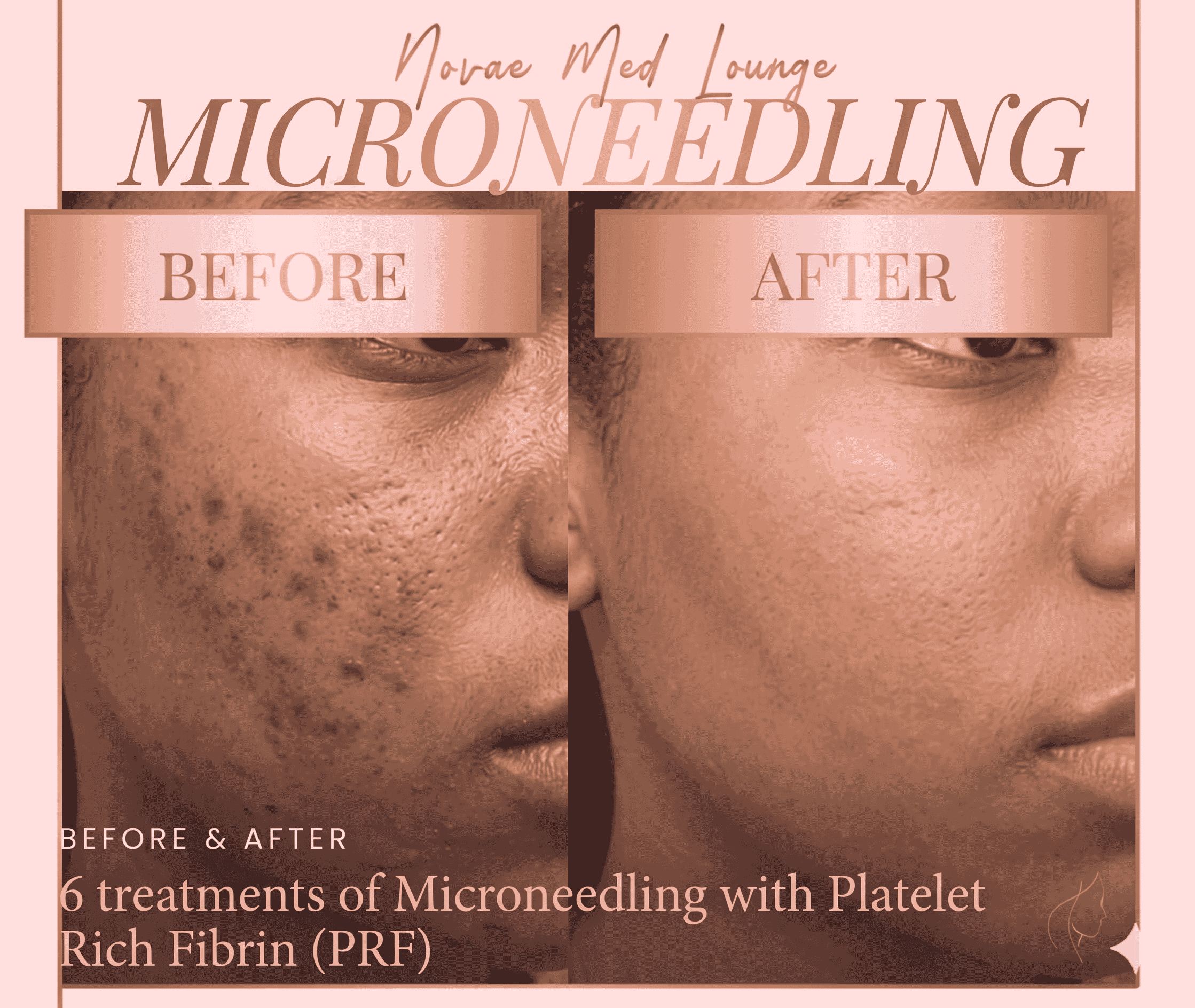 Microneedling