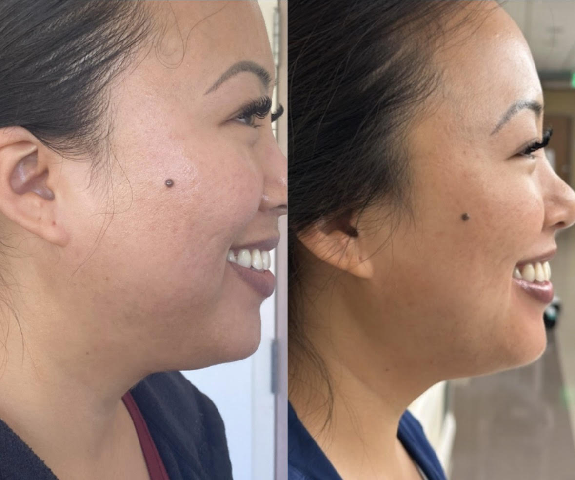 PRF Under Eye Results
