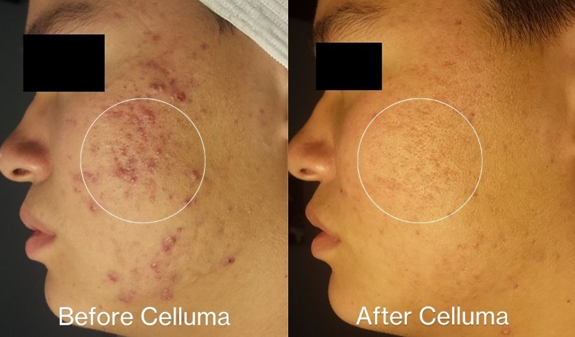 Close-up of cheek with improved occurrence of red acne and inflamed skin after treatment.