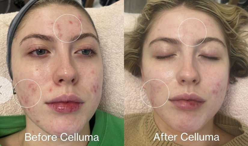 Picture of face with heavy occurrence of acne and inflammation. Before treatment.