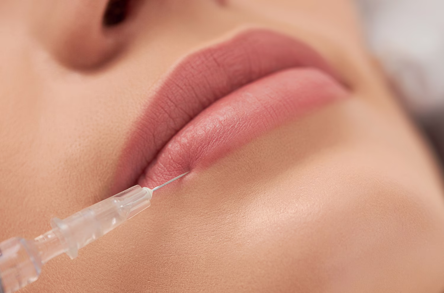 Dermal filler injection in the lips for subtle volume