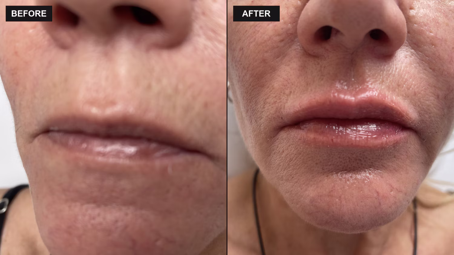 Dermal filler before and after result