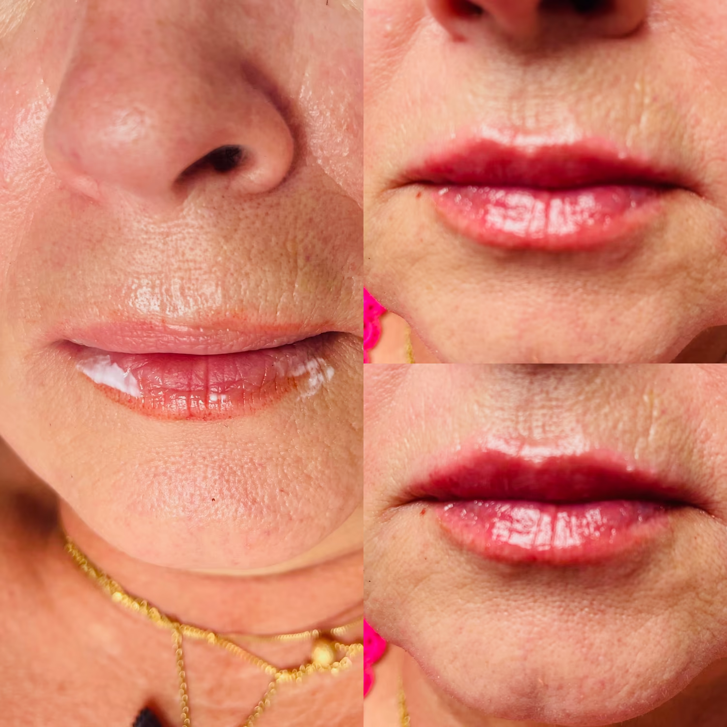 Dermal filler before and after result