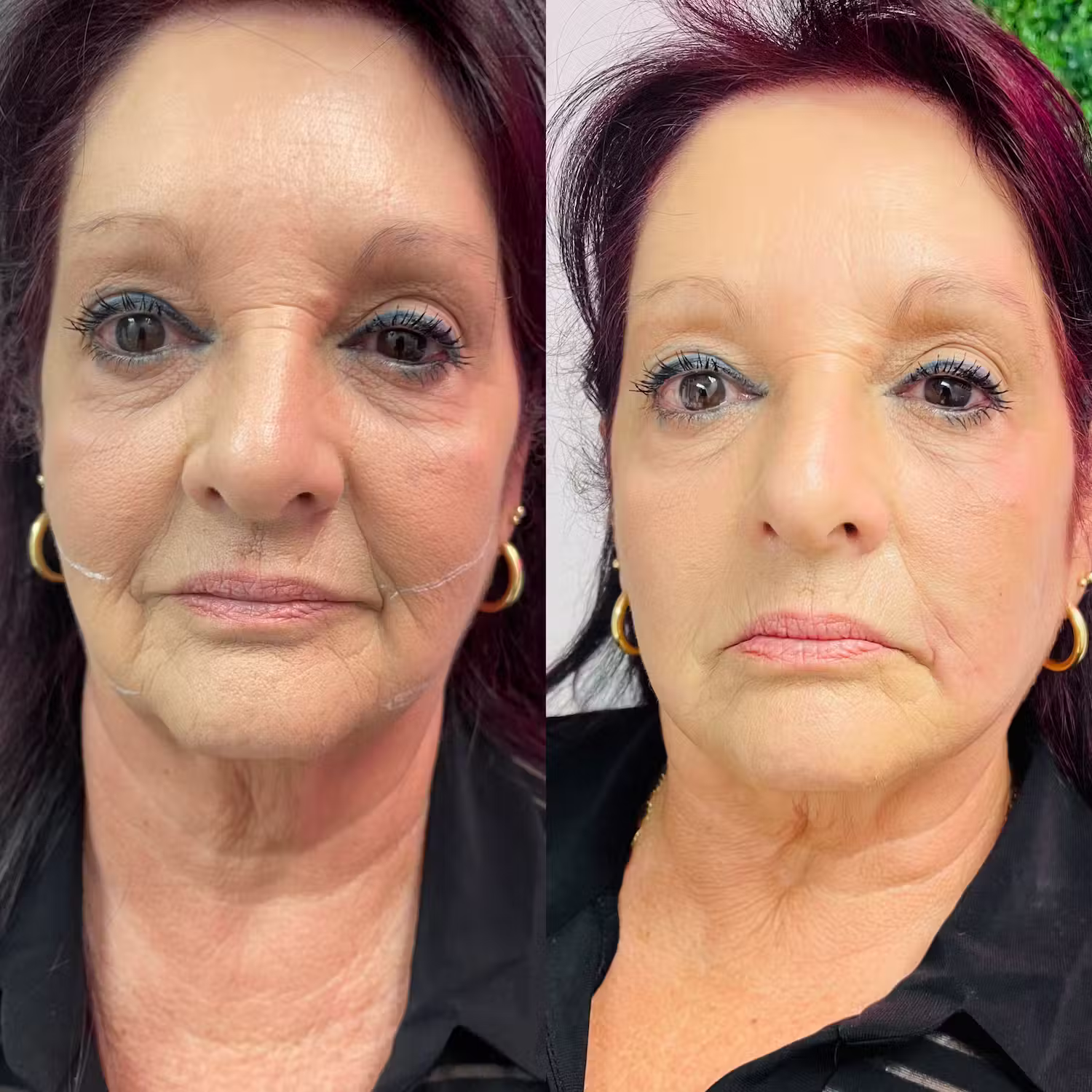 Dermal filler before and after result