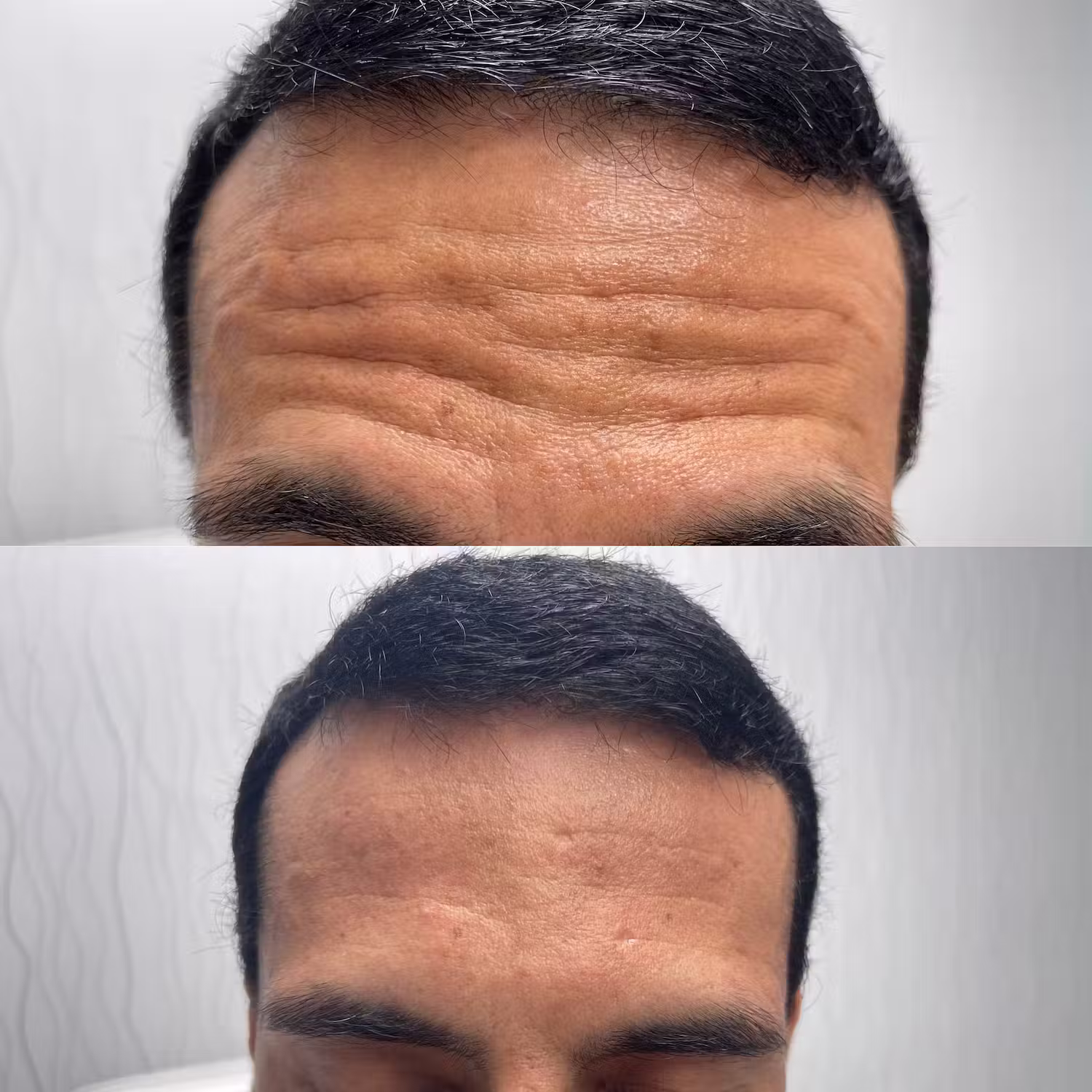 Botox before and after result