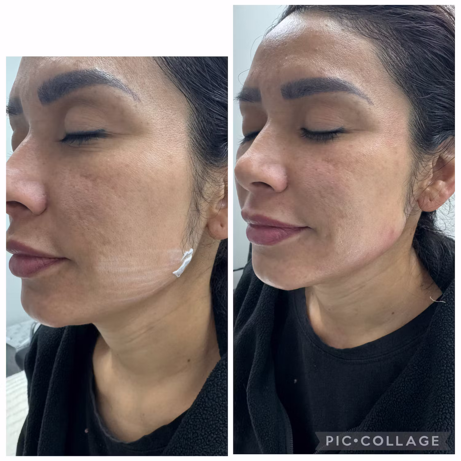 Dermal filler before and after result