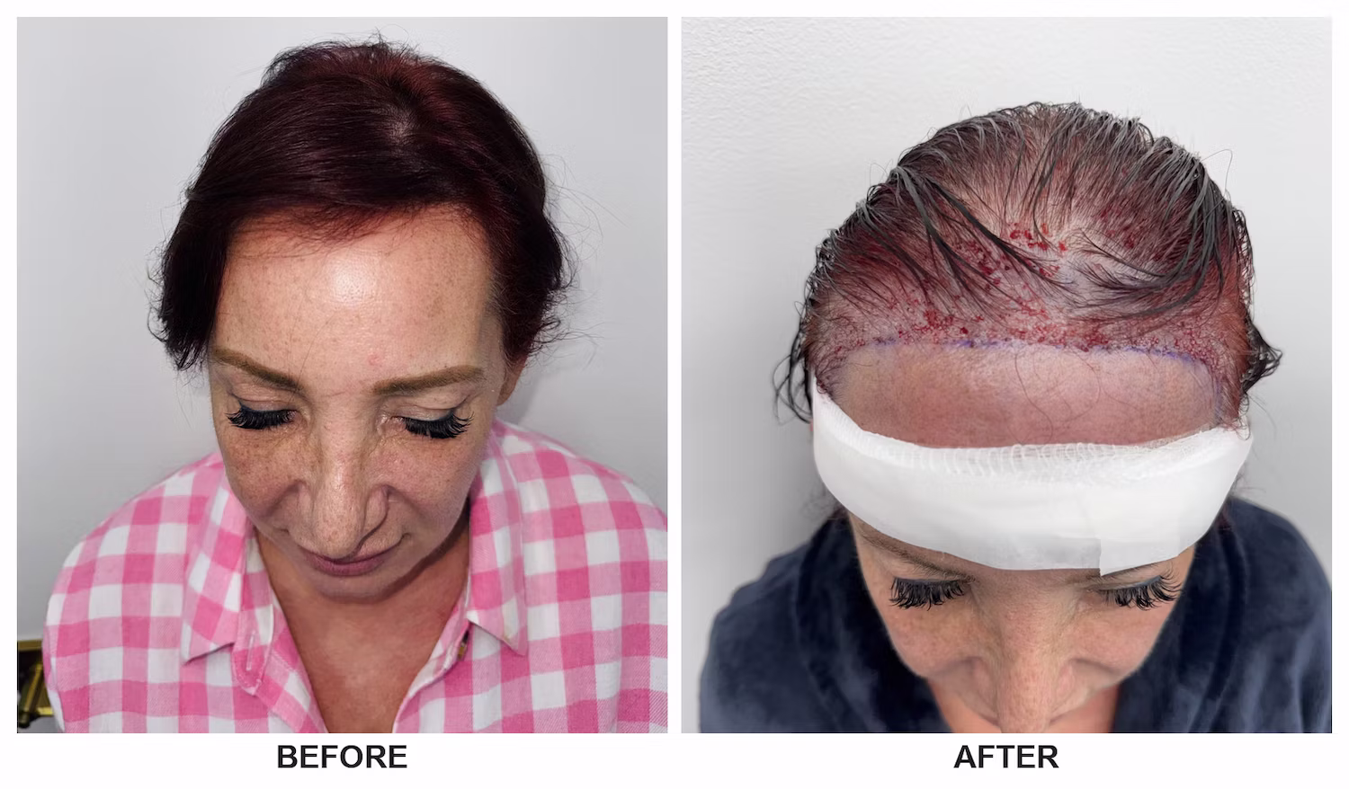 FUE hair transplant before and after result
