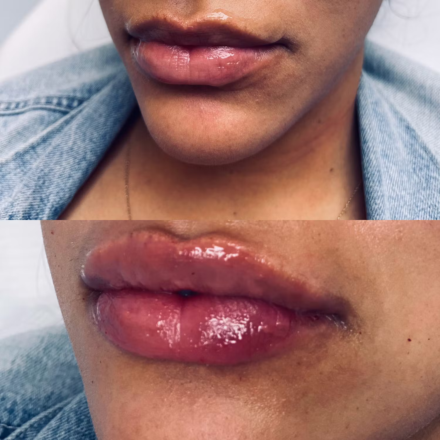 Dermal filler before and after result