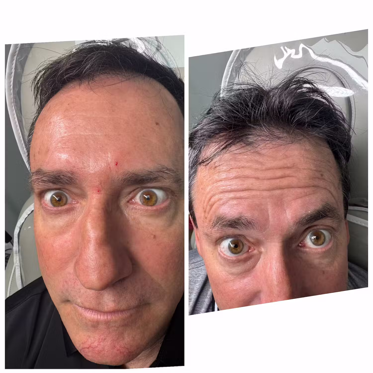 Botox before and after result