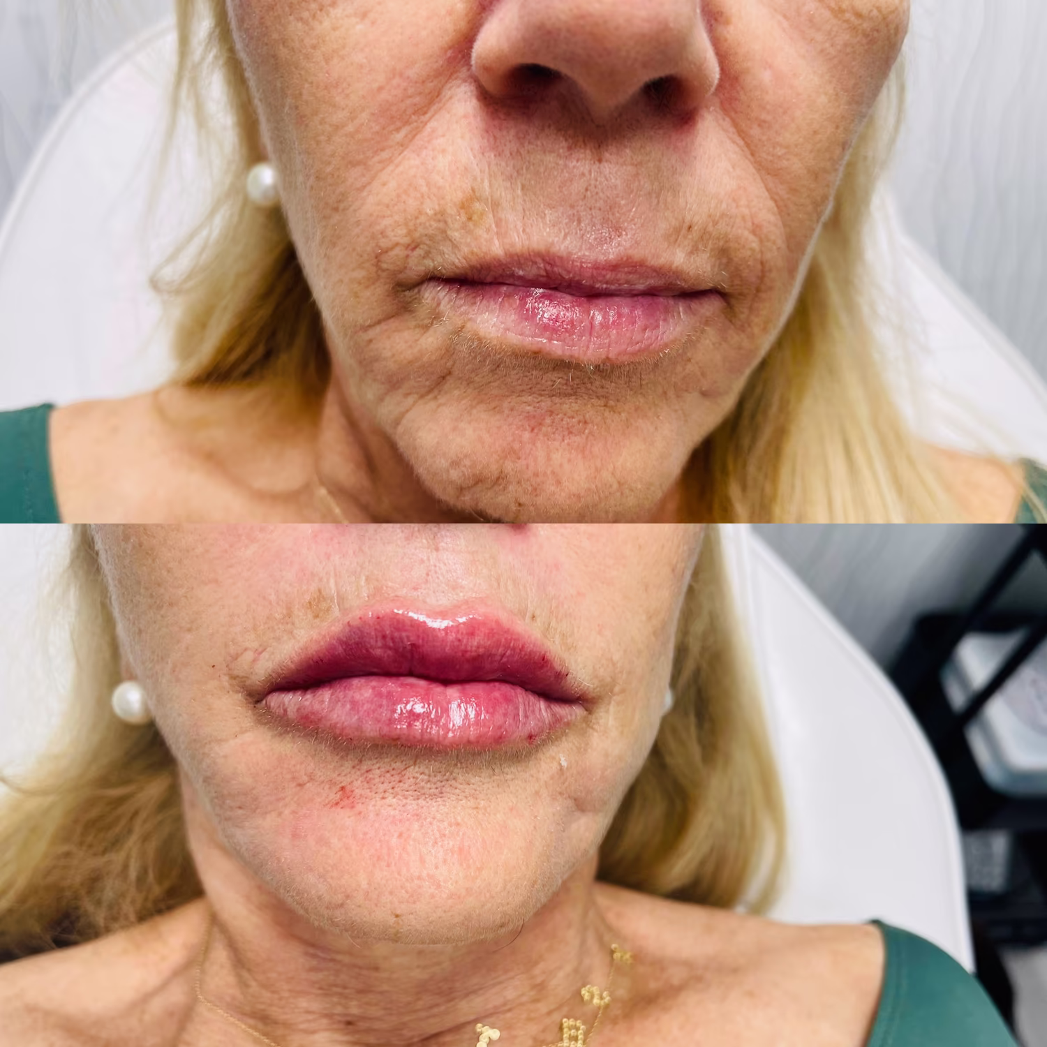 Dermal filler before and after result