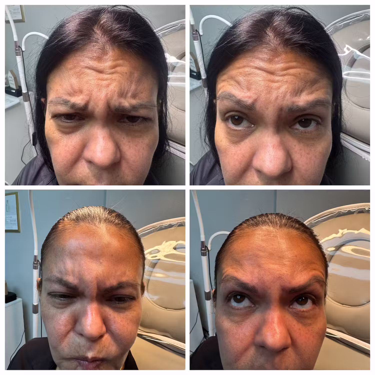 Botox before and after result