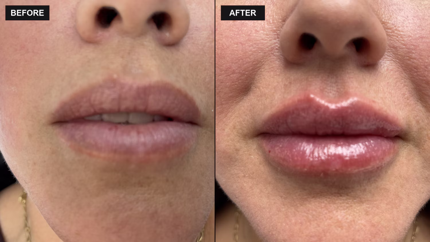 Dermal filler before and after result